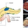 10 Foods Linked with Cancer You Should Never Eat Again