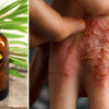 All-Natural DIY Eczema Cream Made from Essential Oils