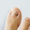 Gross Video Showing what Happens when Fungal Toenail Infection Is Untreated for a Year