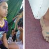 11-Year-Old Girl Wins Gold Medals Wearing ‘Shoes’ Made from Bandages