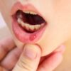 Canker Sores Can Hurt like Hell: Here Are 5 Ways to Relieve Them at Home