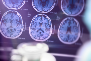 Alzheimer’s Disease Might Be Reversed by Restoring Brain Energy Balance, New Study Finds