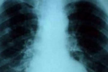 Add 3 Drops of Oregano Oil to Water & See what Happens to the Lungs