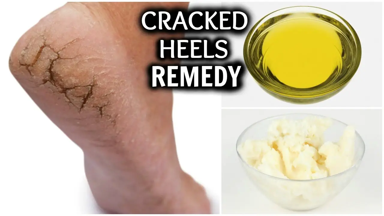 How To Heal Your Cracked Feet With These 6 Home Remedies Best Folk Medicine