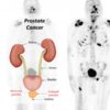 Unusual Signs of Prostate Cancer most Men Do not Know