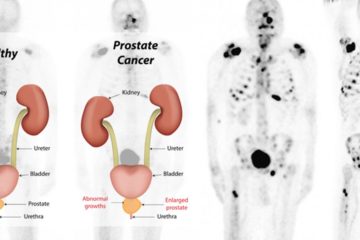 Unusual Signs of Prostate Cancer most Men Do not Know