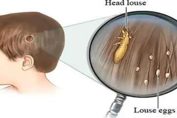 Doctors Will not Tell You this- Cheap Way to Get Rid of Lice Instantly