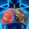Early Symptoms of Lung Cancer You Should not Ignore