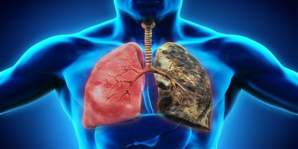 Early Symptoms of Lung Cancer You Should not Ignore