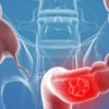 7 Colon Cancer Warning Signs You should never Ignore