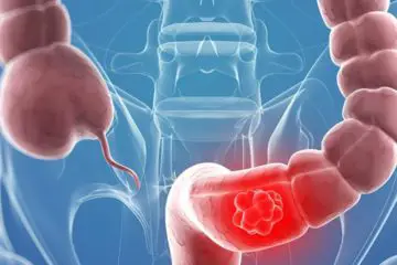 7 Colon Cancer Warning Signs You should never Ignore