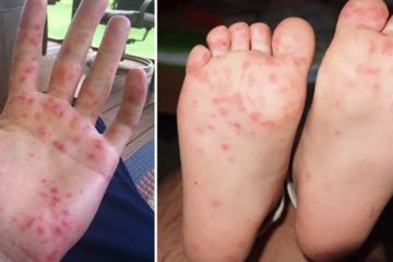 Hand-Foot-and-Mouth Disease on the Rise: Experts Beg Parents to Learn the Warning Signs