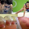 Cupping Therapy can Reduce Pain, Boost the Immunity & Improve the Digestion