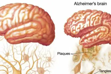 This Vitamin Deficiency Increases the Risk of Alzheimer’s