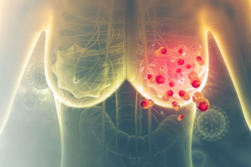 5 Rarely Discussed Early Signs of Breast Cancer