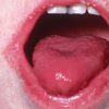 Scarlet Fever Is Back: Every Parent Needs to Watch Out for These Warning Signs
