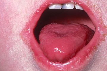 Scarlet Fever Is Back: Every Parent Needs to Watch Out for These Warning Signs