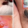 Warning: If You See this Bug around You Go to a Doctor Immediately