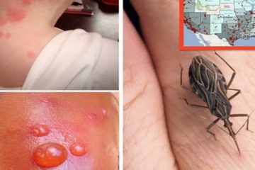 Warning: If You See this Bug around You Go to a Doctor Immediately