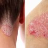 How to Detoxify & Get Rid of Psoriasis once & for All