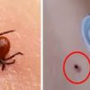 Experts Warn that this Viral Video of a Woman Getting Rid of a Tick with Peppermint Oil Is Highly Dangerous