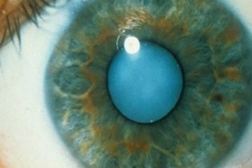 How to Use Castor Oil to Dissolve Cataracts & Get 20/20 Vision