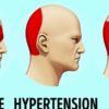 How to Get Rid of Headaches without Pills
