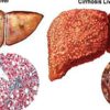 Top 7 Herbs to Cure Your Liver