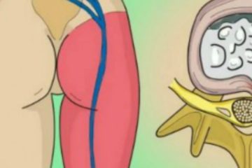 How to Release the Pinched Nerve in the Lumbar Area (Sciatica) - 2 Simple Ways