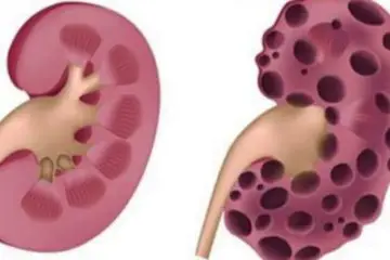10 Deadly Everyday Habits which Damage Your Kidneys beyond Repair