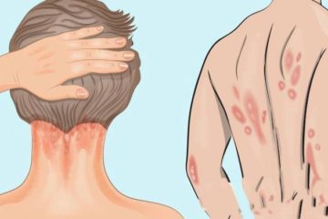Psoriasis: Causes, Symptoms & the Vitamin You Are Missing