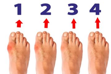 Bunions: What They Are & How to Treat Them