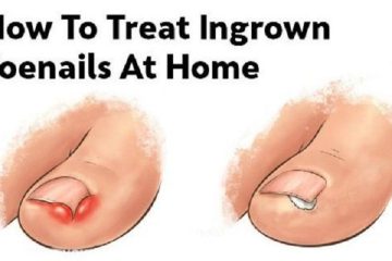 5 Beneficial & Effective DIY Remedy for Ingrown Toenails