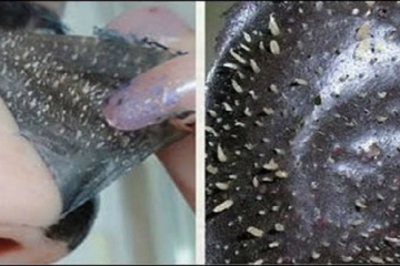 How to Remove Pimples overnight Naturally & Fast