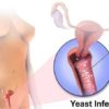 Women Who Suffer from Fungal Infections can Cure Themselves at Home (Best & most Effective Natural Remedies)