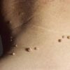 Easy, Effective & Cheap DIY Remedy to Remove Skin Tags