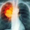 Groundbreaking Discovery: Scientists in Amsterdam Destroyed Breast Cancer without Chemo in 11 Days