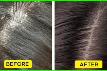 The Different Types of Dandruff & How to Treat Them