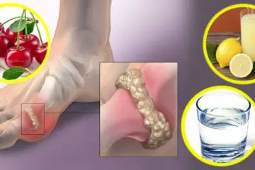6 Natural Remedies to Remove Uric Acid Crystal Deposits in the Joints