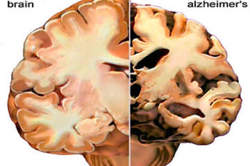 Scientists Are Warning Us: Lacking One Vitamin can Cause Dementia & Autism