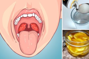 Caught a Strep Throat Infection? Try Out these 5 Natural DIY Remedies