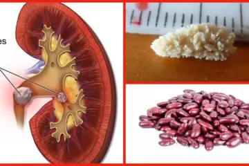 Best Natural Remedies to Ease the Removal of Kidney Stones