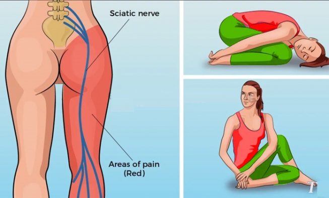 Yoga Poses For Sciatica Pain Yoga poses to soothe sciatic nerve pain in 15 minutes Yoga Poses For Sciatica Pain Yoga poses to soothe sciatic nerve pain in 15 minutes