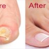 DIY Nail Fungus Remedy with Baking Soda & Apple Cider Vinegar