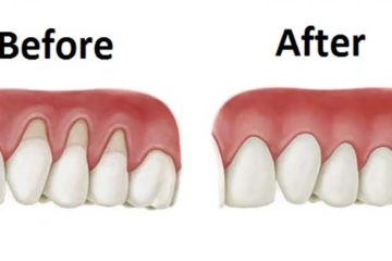 5 Home Remedies to Relieve Inflamed Gums Naturally at Home