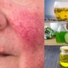 7 Beneficial DIY Remedies for Rosacea that actually Work
