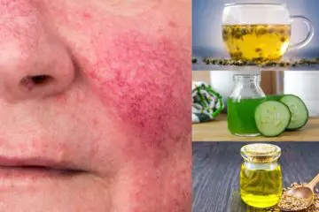 7 Beneficial DIY Remedies for Rosacea that actually Work