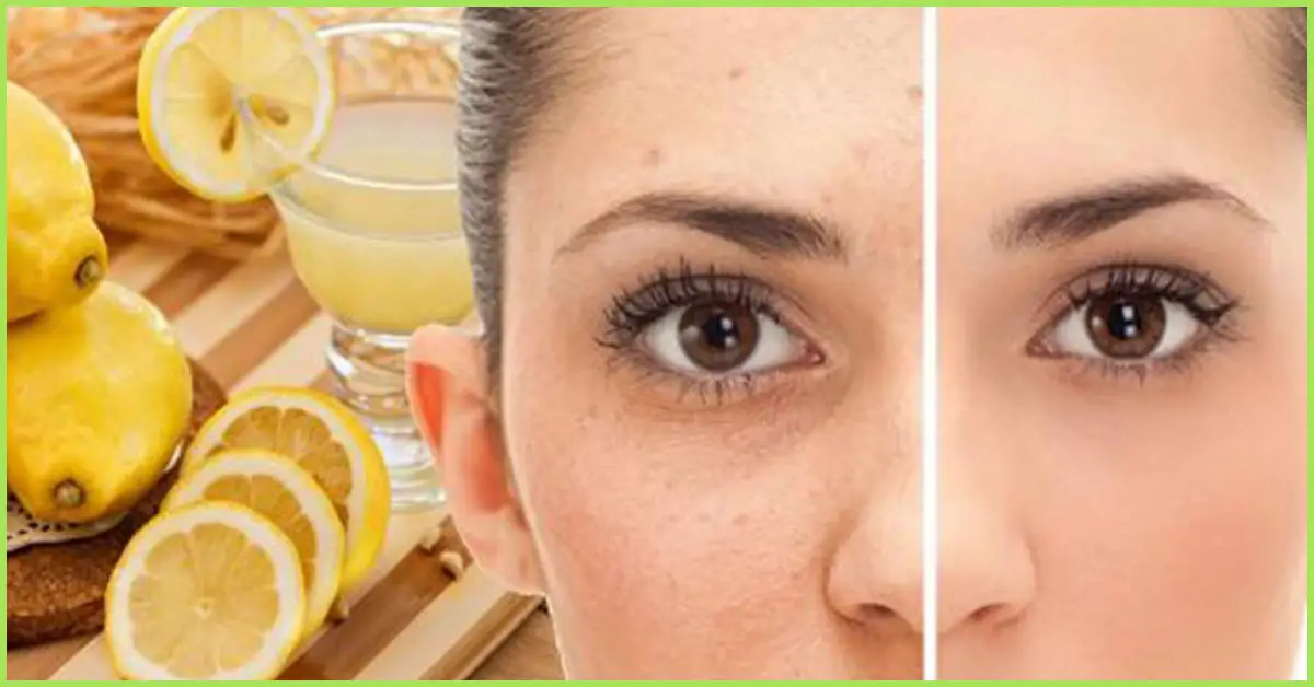 Remove Freckles And Brown Spots With This Amazing Diy All Natural Remedy 9305