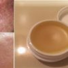 Unique DIY Scar Removal Cream: Removes Scars Long-Term within 2 Weeks
