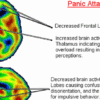 Important Discovery: Panic Attacks & Anxiety Linked to Vitamin & Iron Deficiency